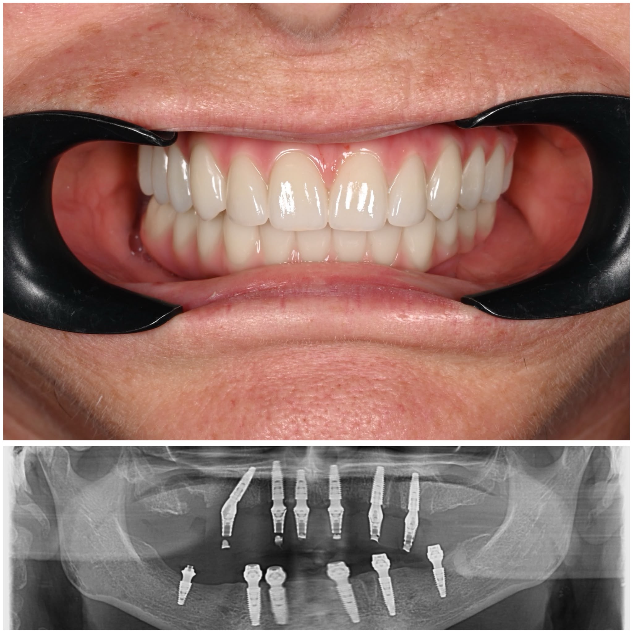 Implantul dentar: tot ce trebuie să știi înainte de tratament